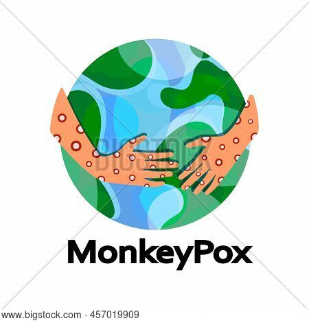 Monkeypox Virus. Eruption On The Body. Monkey Pox Virus Disease Symptoms On Hands Rash Infection. Gl