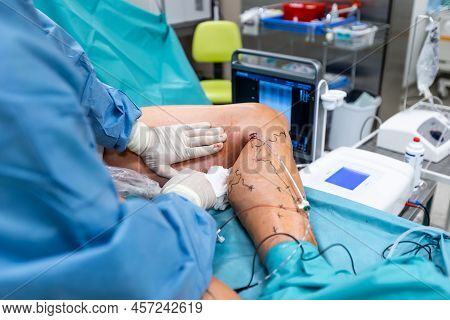 Varicose Veins Surgery Act, A Superficial Veins Problems, Swollen Skin