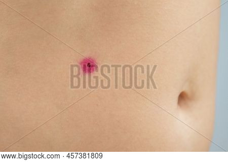 Close-up Of A Removed Wart On A Womans Abdomen. Human Papillomavirus After Burning.