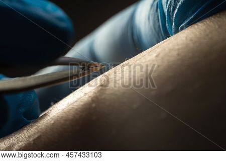 Doctor Hair Removal Specialist, Professional Electro Epilation Hair From Woman's Legs With Tweezers,