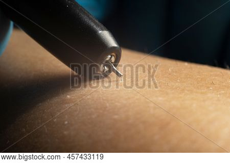 Close Up Process Of Permanent Unwanted Hair Removal, Using An Electroepilation Device In Beauty Salo