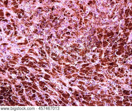 Human Lymph Node. Metastasis Of A Malignant Melanoma. The Normal Lymphoid Tissue Of Lymph Node Has C