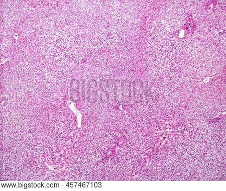 Light Micrograph Of A Human Liver With A Generalized And Intense Steatosis (fatty Liver). This Condi