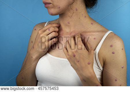 Causacian Woman Scratches Red Spots Because Of Monkeypox