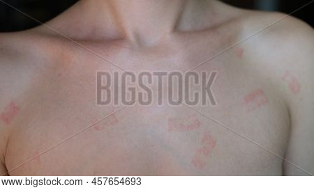 Red Itchy Patch Rash On Woman Skin Closeup. Diagnosis And Treatment Of Contact Dermatitis Concept