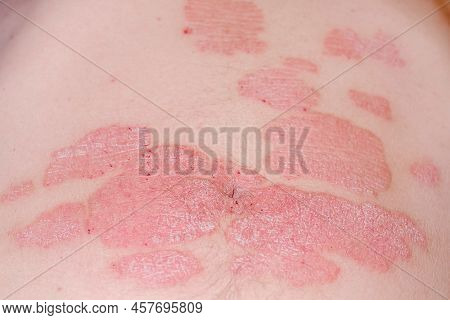 Acute Psoriasis On The Stomach In A Man, Severe Redness On The Skin, An Autoimmune Incurable Dermato