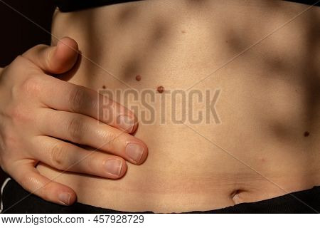Birthmarks On Skin Close Up Detail Of The Bare Skin Sun Exposure Effect On Skin, Health Effects Of U