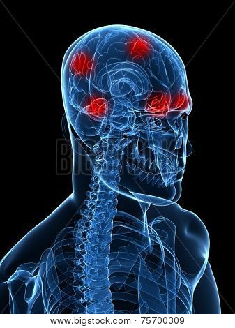 headache