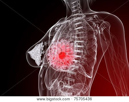breast cancer illustration
