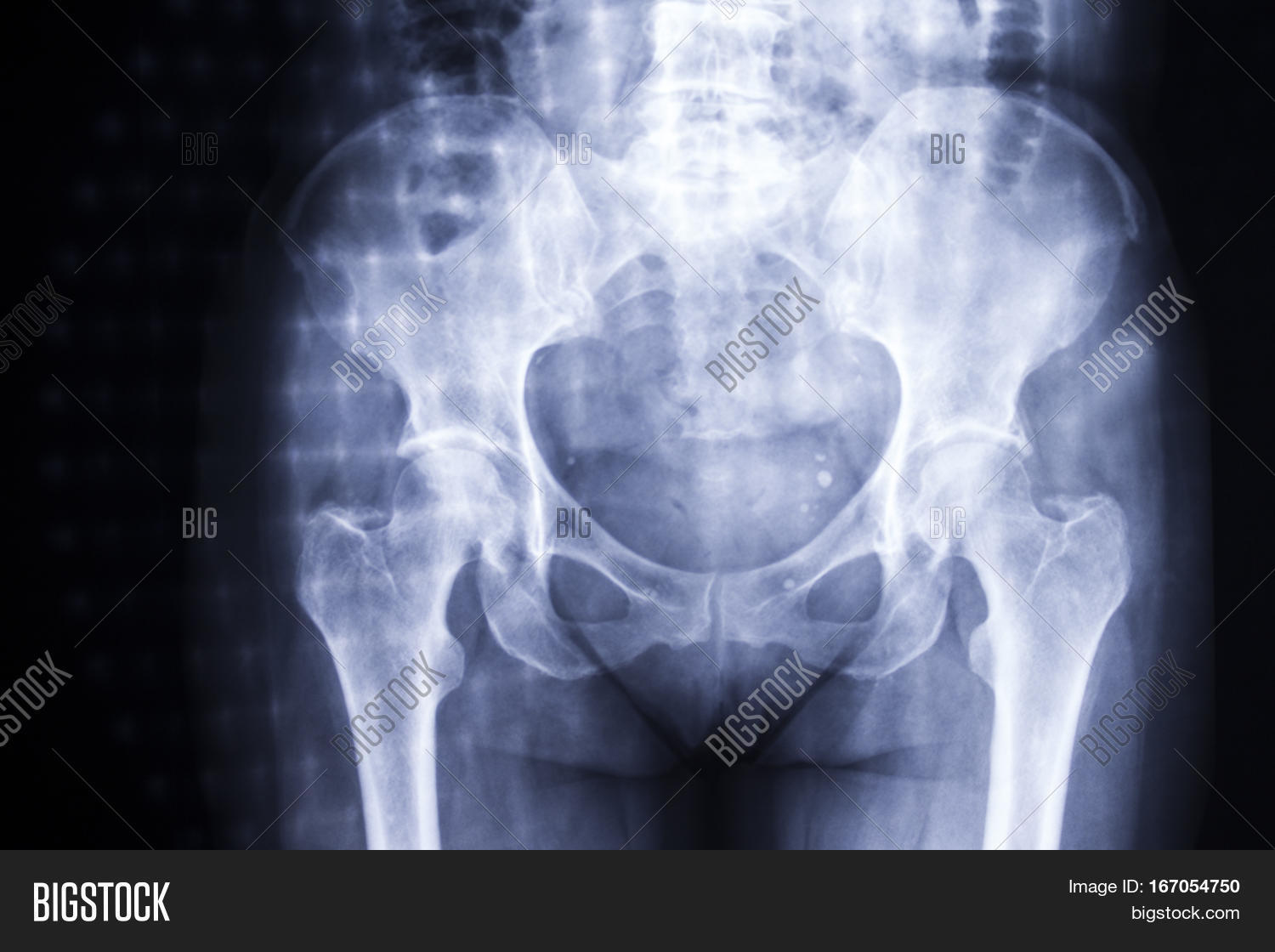 Women Hips On Xray. Image & Photo (Free Trial) Bigstock