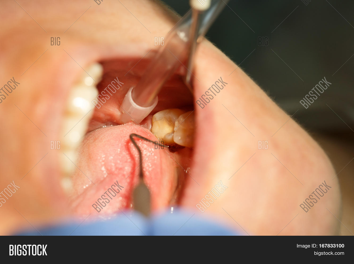 molar teeth