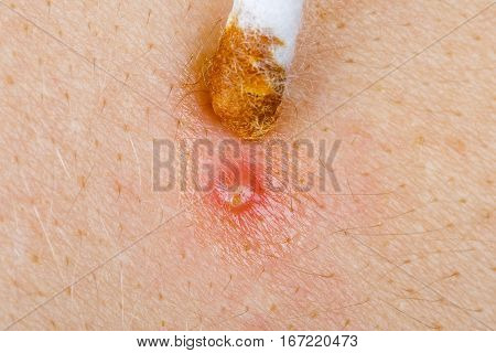 Photo of acne home remedy with propolis