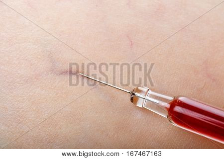 Close up photo of injection treatment on human skin