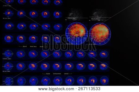 Mrt Of The Heart And Coronary Vessels Using Contrast Fluid And Stress