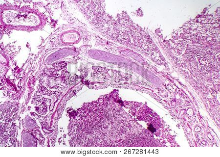Histopathology Of Bronchopneumonia, Light Micrograph, Photo Under Microscope