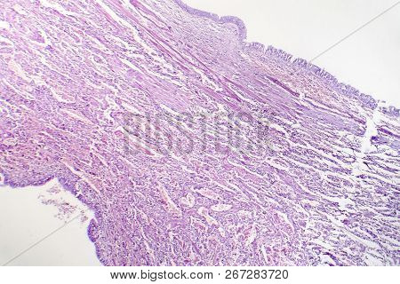 Histopathology Of Viral Pneumonia, Light Micrograph, Photo Under Microscope