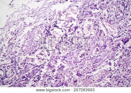 Histopathology Of Viral Pneumonia, Light Micrograph, Photo Under Microscope