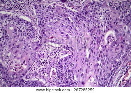 Squamous Cell Carcinoma Of The Lung, Light Micrograph, Photo Under Microscope