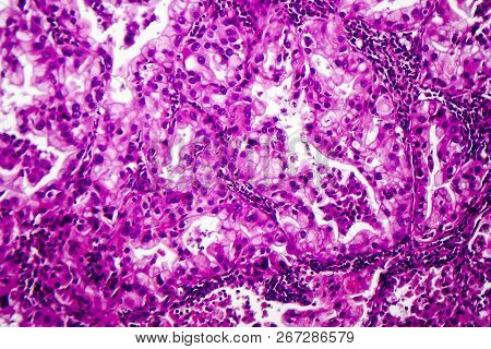 Histopathology Of Lung Cancer, Light Micrograph, Photo Under Microscope