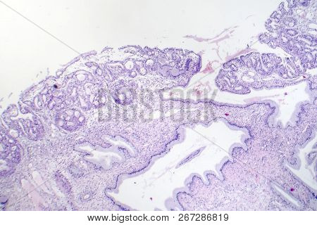Histopathology Of Nasal Polyps, Light Micrograph, Photo Under Microscope