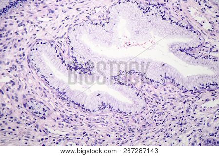 Histopathology Of Nasal Polyps, Light Micrograph, Photo Under Microscope
