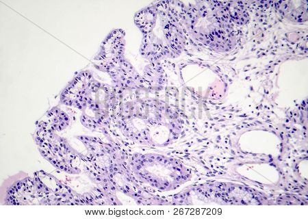 Histopathology Of Nasal Polyps, Light Micrograph, Photo Under Microscope