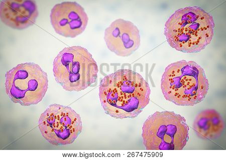 Meningococcal Meningitis, Cerebrospinal Fluid Smear Containing Neutrophils With And Without Bacteria