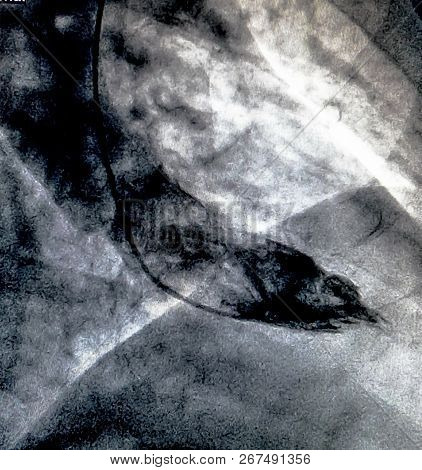 Catheterization. Cardiac Ventriculography Is A Medical Imaging Test Used To Determine A Patient Card