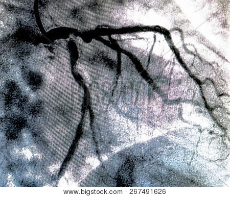 Catheterization. Cardiac Ventriculography Is A Medical Imaging Test Used To Determine A Patient Card