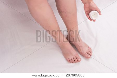 An Elderly Woman Applies Healing Ointment To Her Leg On Varicose Veins, Phlebeurysm Legs, Woman, Whi