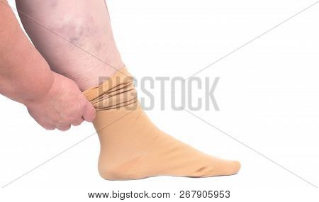 Woman Putting On The Leg Medical Stocking For Varicose Veins On The Legs, White Background, Isolate,