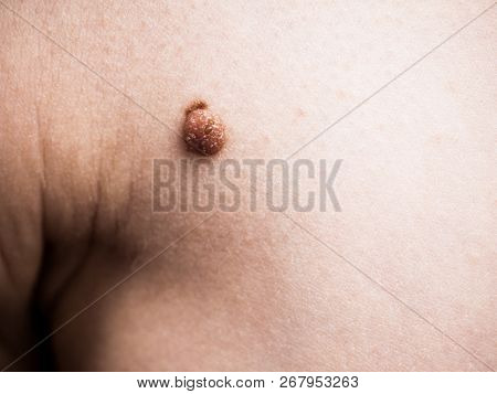 Unrecognizable Person Having Dark Fibroma, Dermatology Problem On Skin. Close Up Of Papilloma Dermat
