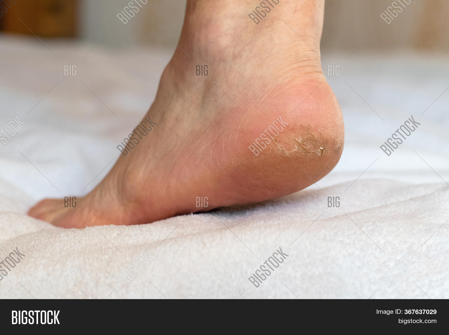 Man's Leg Cracks On Image & Photo (Free Trial) Bigstock