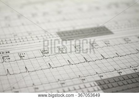 Three-channel Holter Ekg Strip Showing Heartbeat Waves. Electrical Activity Of The Heart Recorded On