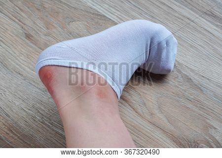 Water Corns On Heels Of A Woman In White Socks, Rub The Calluses With New Shoes. Grated Bloody Blown