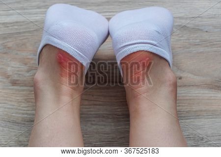 Water Corns On Heels Of A Woman In White Socks, Rub The Calluses With New Shoes. Grated Bloody Blown