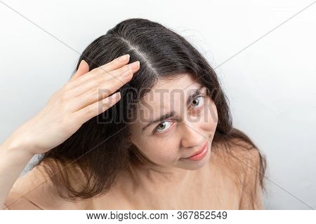 Dandruff And Seborrhea. Portrait Of A Young Woman With Dark Hair, Anxiously Brushing Dandruff From H