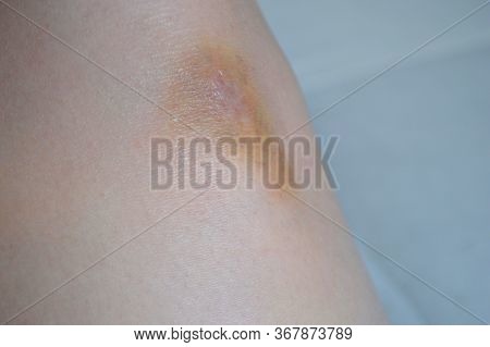 Woman Applying Cream On Bruised Knees. Bruise On The Knee On A Light Background. Medical Worker Day.
