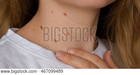 Unrecognizable Woman Showing Her Birthmarks On Neck Skin Close Up Detail Of The Bare Skin Sun Exposu
