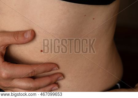 Unrecognizable Woman Showing Her Birthmarks On Skin Close Up Detail Of The Bare Skin Sun Exposure Ef