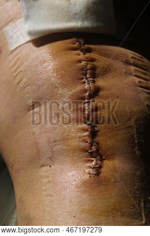 Surgical Suture On The Knee. Surgical Wound Sutured With Special Metal Suture For Healing. Total Kne