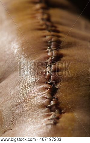 Surgical Suture On The Knee. Surgical Wound Sutured With Special Metal Suture For Healing. Total Kne