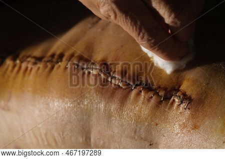 Surgical Suture On The Knee. Surgical Wound Sutured With Special Metal Suture For Healing. Total Kne