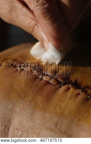 Surgical Suture On The Knee. Surgical Wound Sutured With Special Metal Suture For Healing. Total Kne