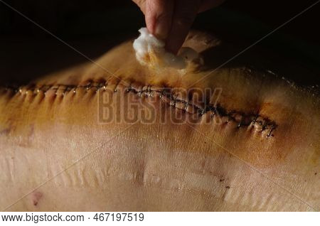 Surgical Suture On The Knee. Surgical Wound Sutured With Special Metal Suture For Healing. Total Kne
