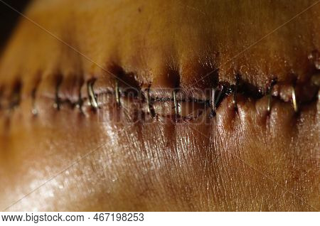 Surgical Suture On The Knee. Surgical Wound Sutured With Special Metal Suture For Healing. Total Kne