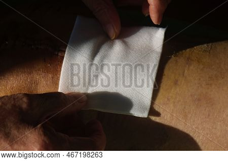 Surgical Suture On The Knee. Surgical Wound Sutured With Special Metal Suture For Healing. Total Kne