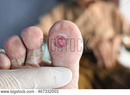 Diabetes Foot Ulcer In The Big Toe Of Asian Male Patient.