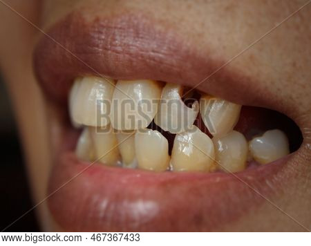 Incisors Partially Perforated On Maxillary Teeth Closeup View