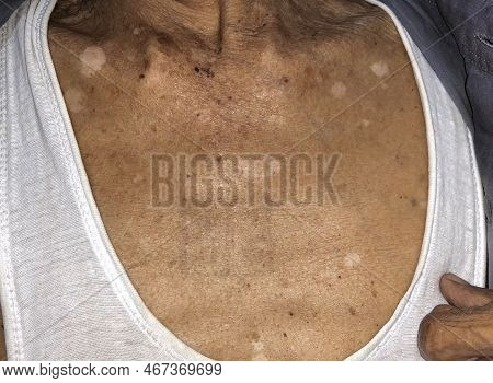 Aging Spots Called Liver Spots, Nevi And White Patches On Chest Of Asian Elder Man.